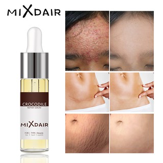 MIXDAIR Acne Scar Removal Serum Stretch Mark Repair Anti Acne Skin Care Facial Treatment Essence 15 ML