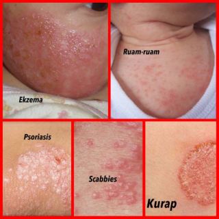 [Shop Malaysia] Psoriasis Cream, Kudis, Eczema, Eczema, Itching, Mujarab Very Goods!!